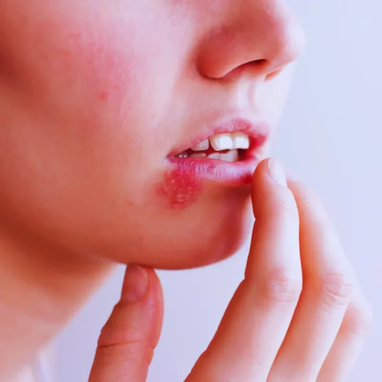 Demystifying Herpes: Understanding the Reality Behind the Condition